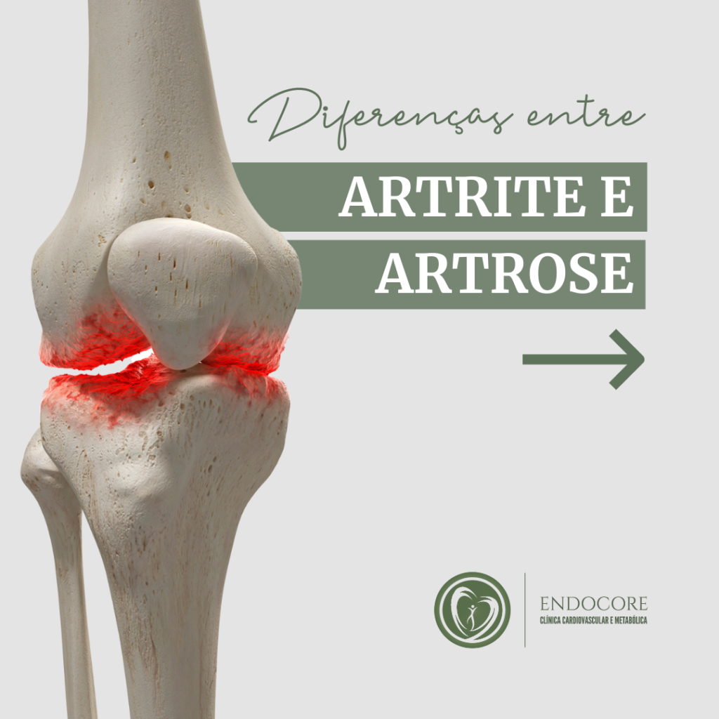 Diferen A Entre Artrite E Artrose Endocore