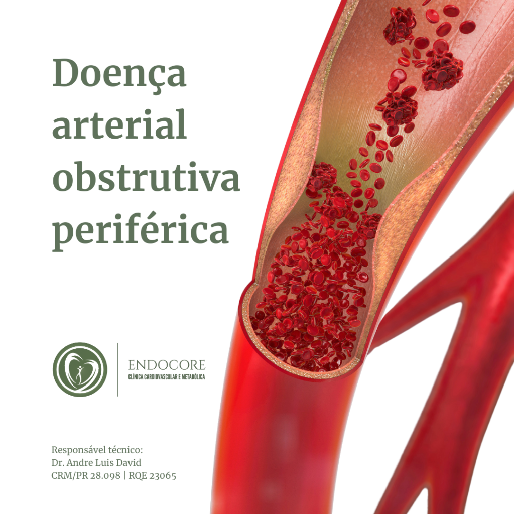 Doença Arterial Obstrutiva Periférica Endocore